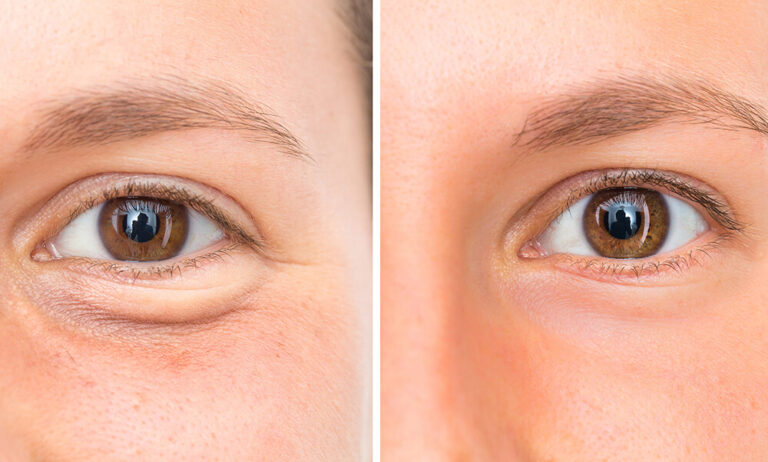 Blepharoplasty in Taksim