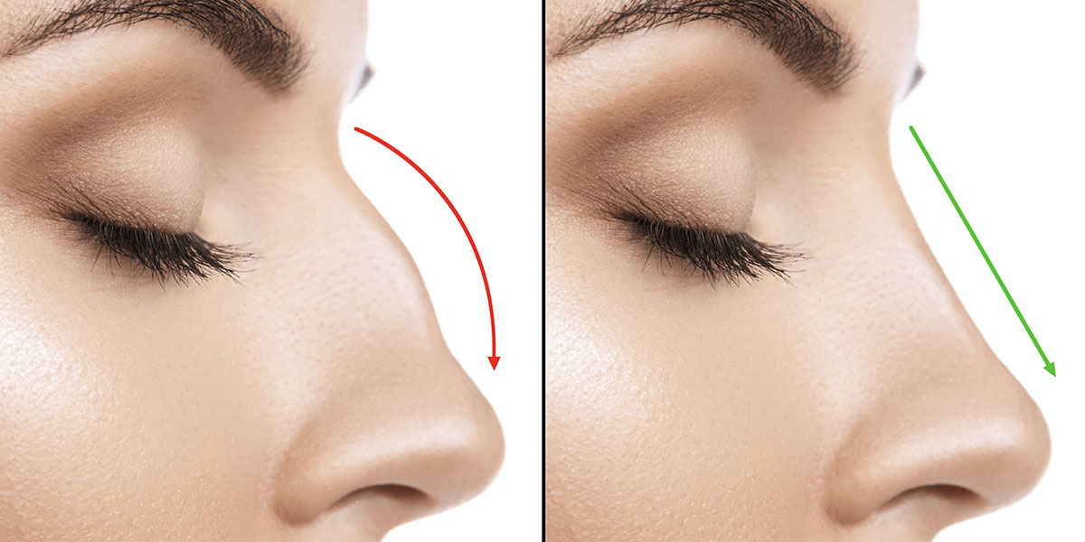 Rhinoplasty in Taksim, Turkey