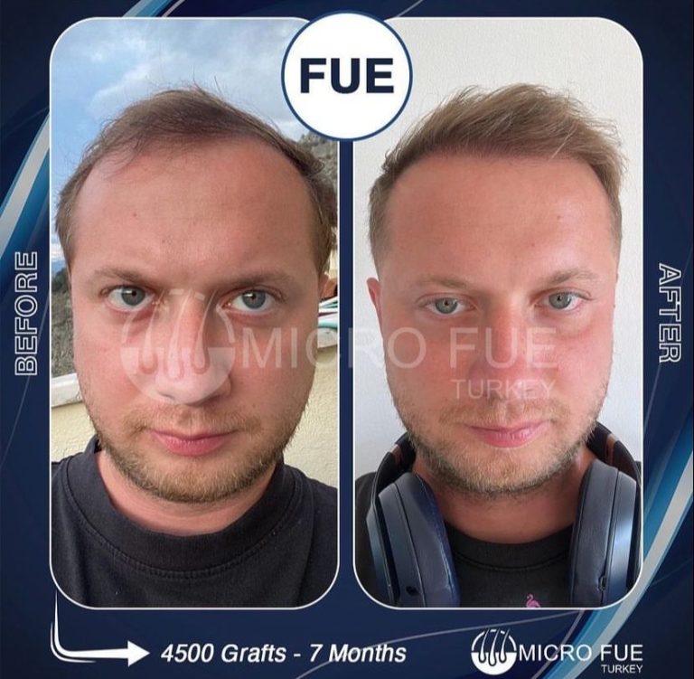 Weak Donor Area Hair Transplant
