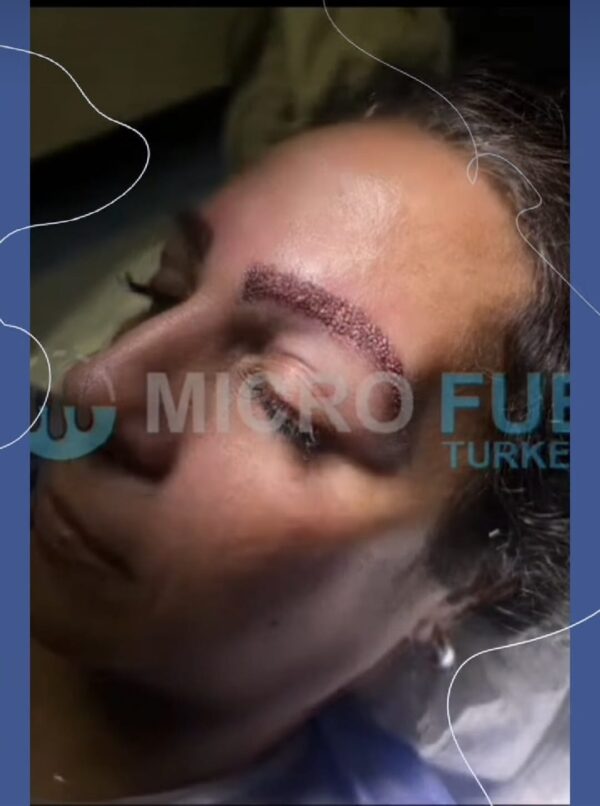 Eyebrow Transplant Procedure in Taksim