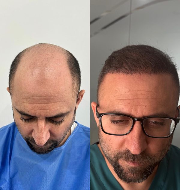 Hybrid Hair Transplant Turkey