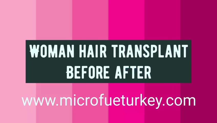 Female Hair Transplant Taksim