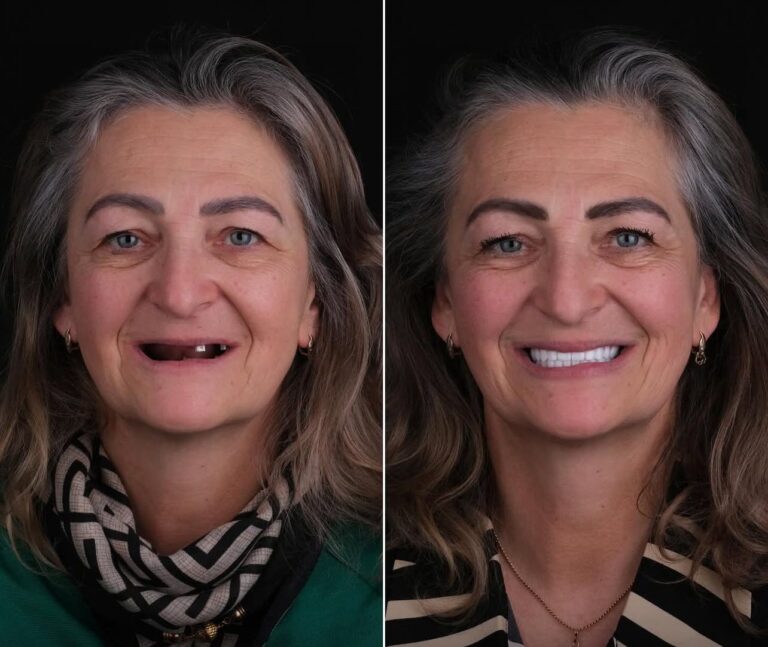 Full Mouth Dental Transformation in Turkey