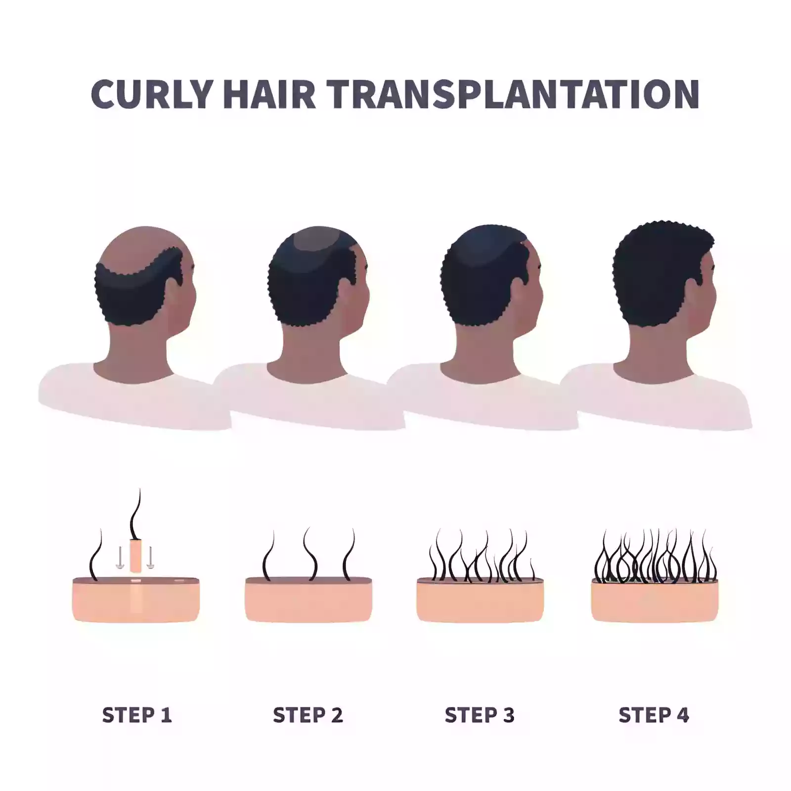 Afro Hair Transplant Istanbul Turkey hairline restoration