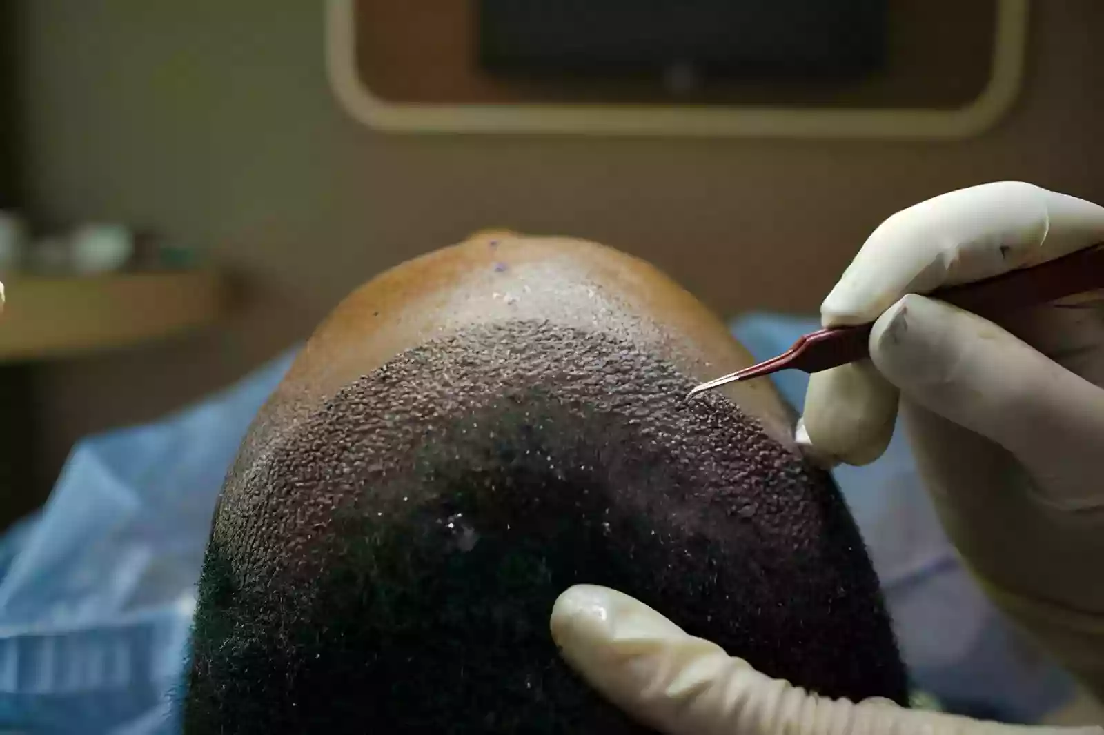 FUE graft extraction for curly hair in Istanbul