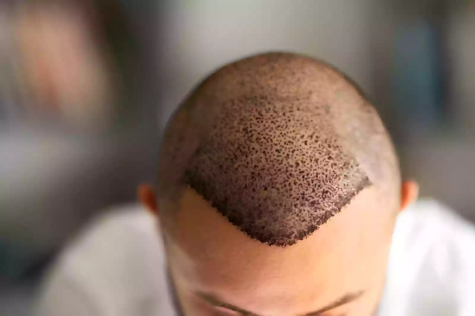 Recovery and hair growth after Afro hair transplant