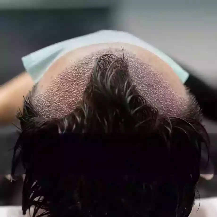 DHI hair transplant procedure planning