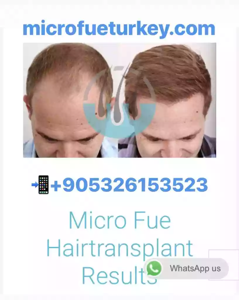 DHI hair transplant for Canadian patients