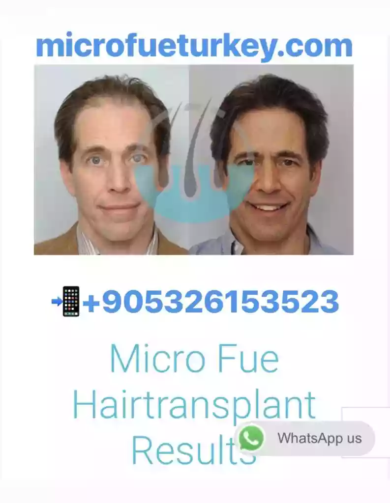 DHI hair transplant for Toronto patients