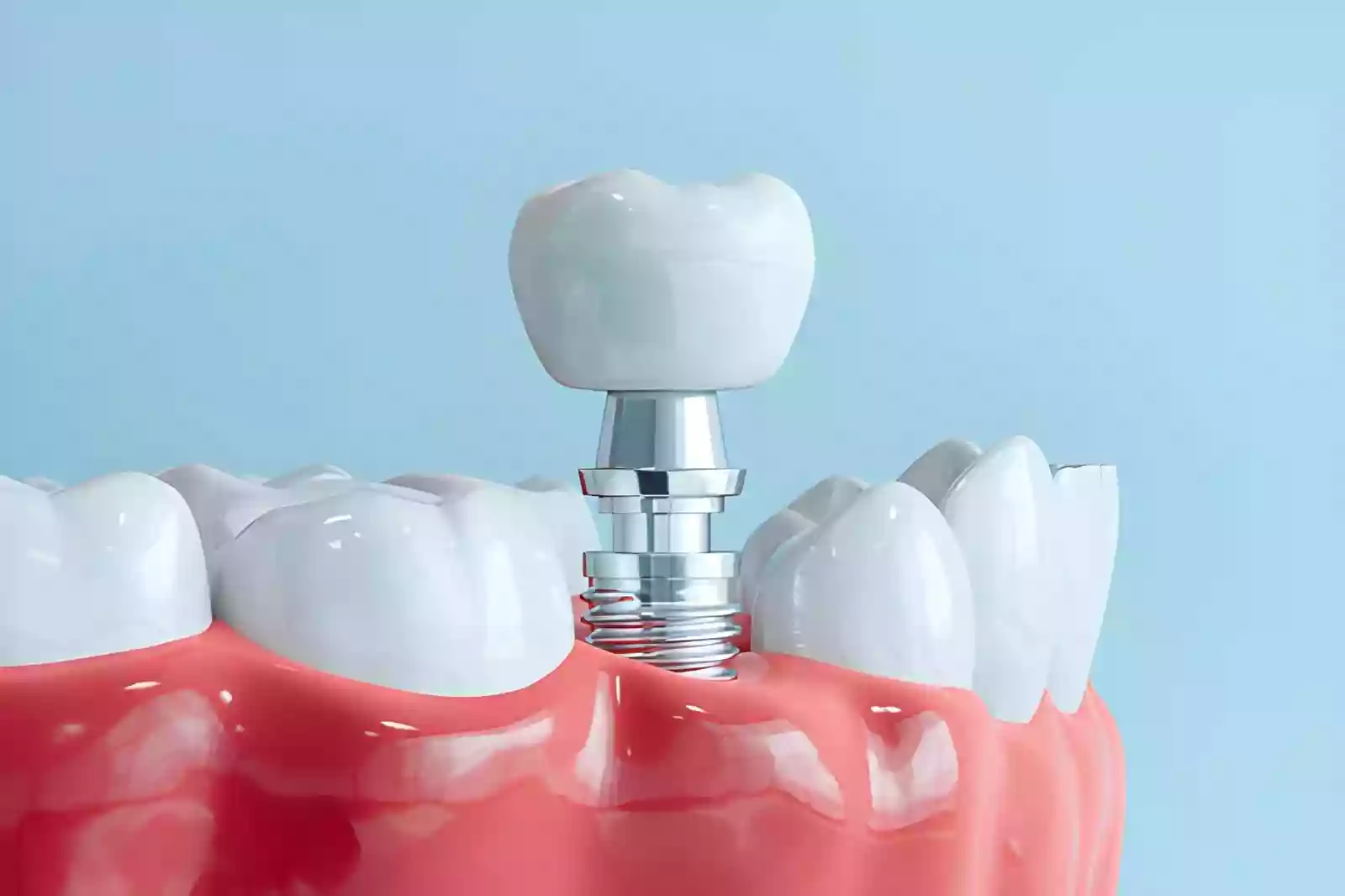 Dental Implants in Taksim