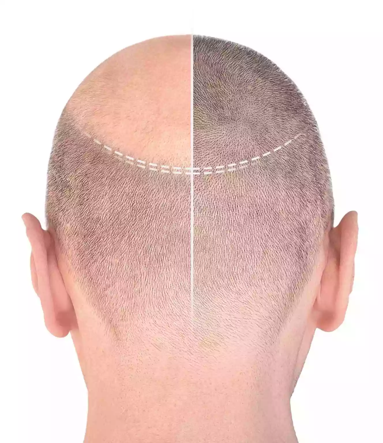 Aftercare after Hair Transplant Turkey from Toronto