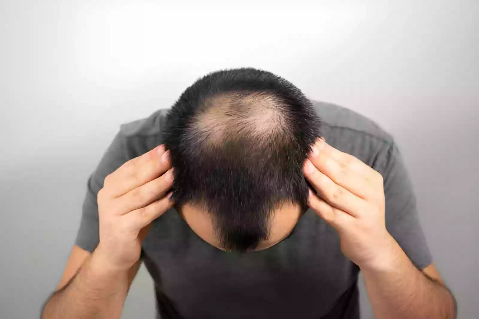 Hair Transplant in Turkey for Canadians