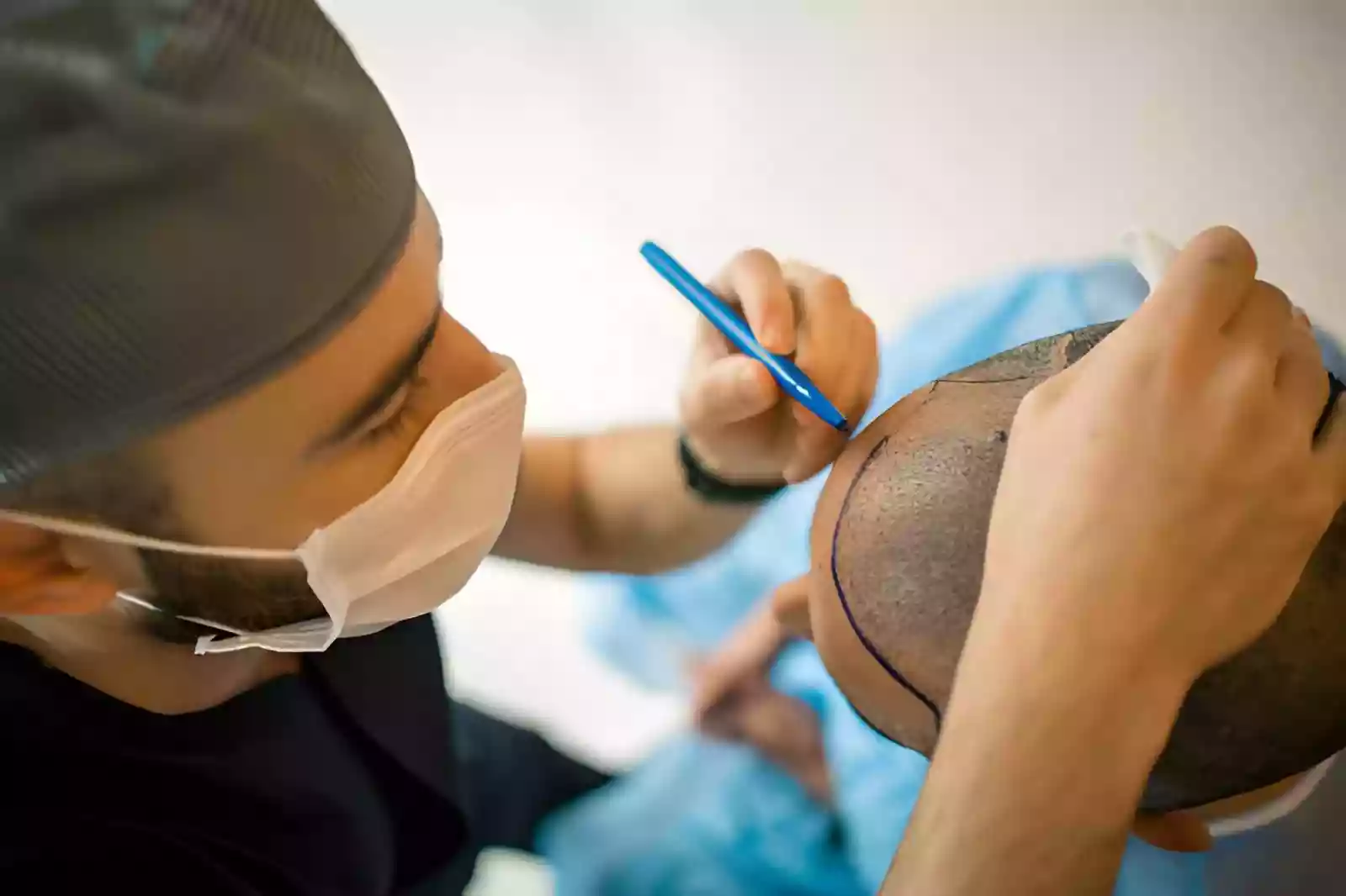Donor assessment for Hair Transplant in Turkey for Canadians