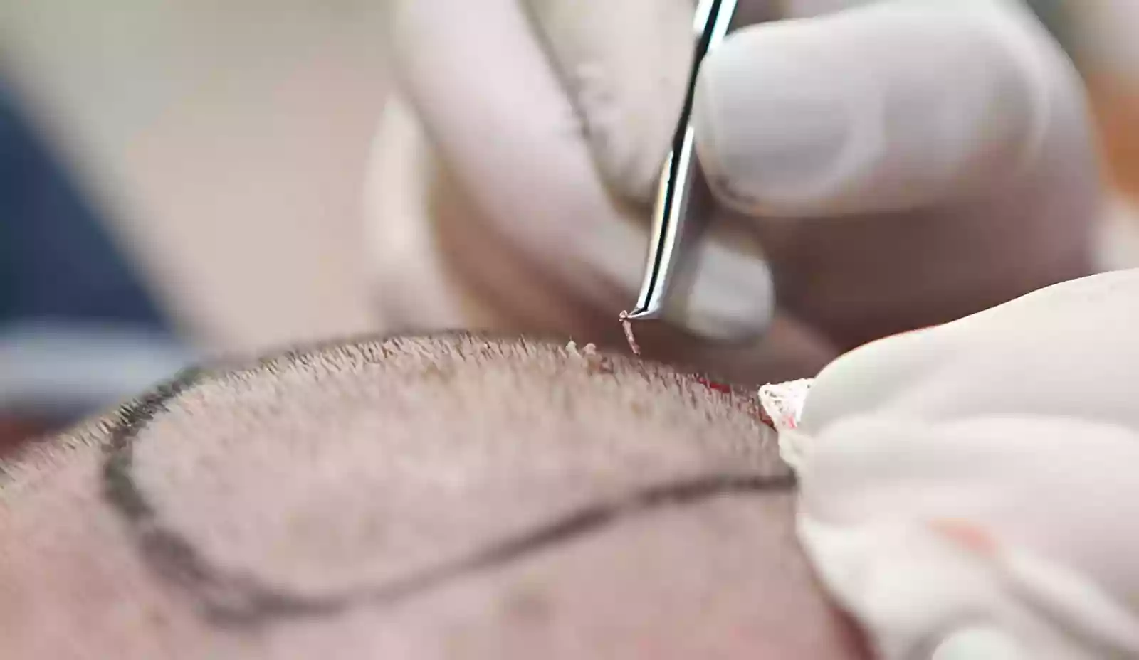 Hair transplant procedure in Istanbul for Canadians