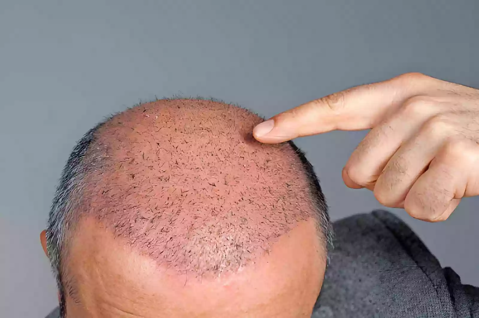 Recovery after Hair Transplant in Turkey for Canadians