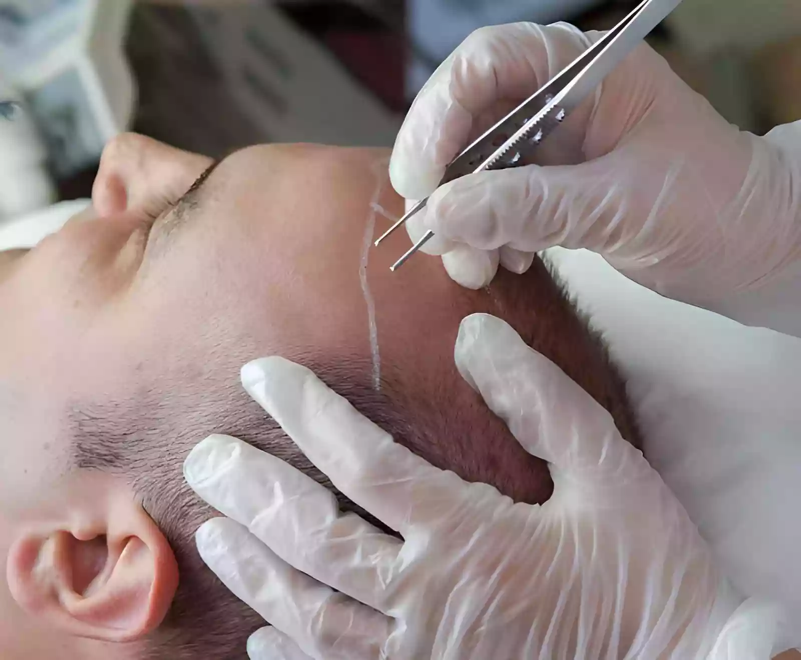 Comparing Hair Transplant Turkey Cost for Canadians