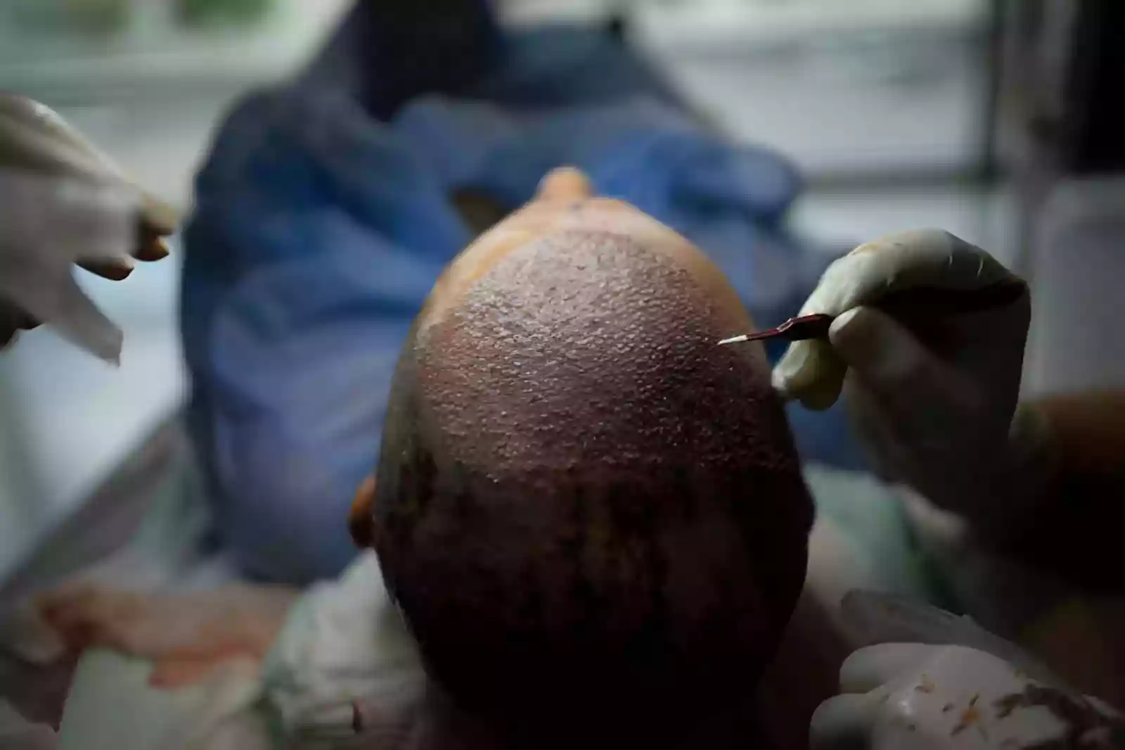 Choosing a hair transplant treatment provider