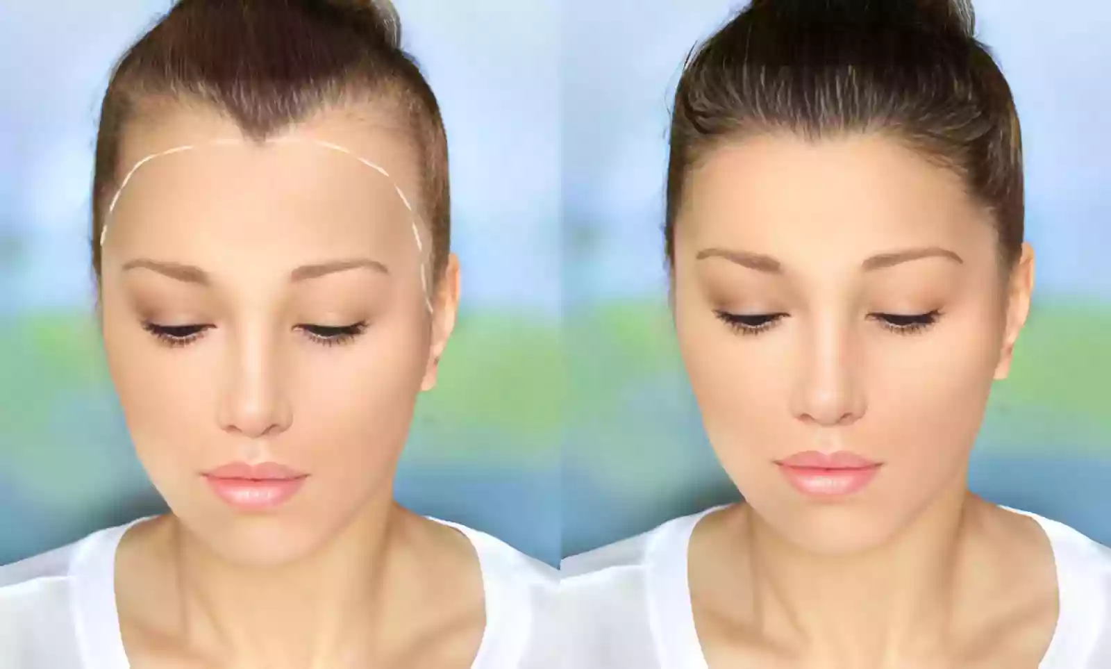 Hair Transplant Taksim hair restoration planning