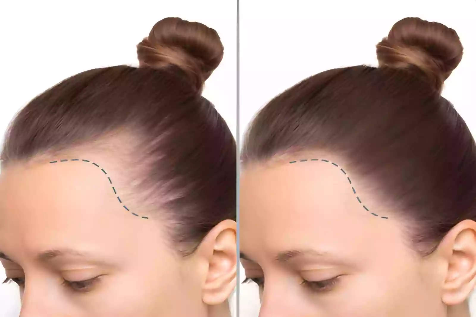 Hair Transplant in Beyoglu consultation and donor assessment