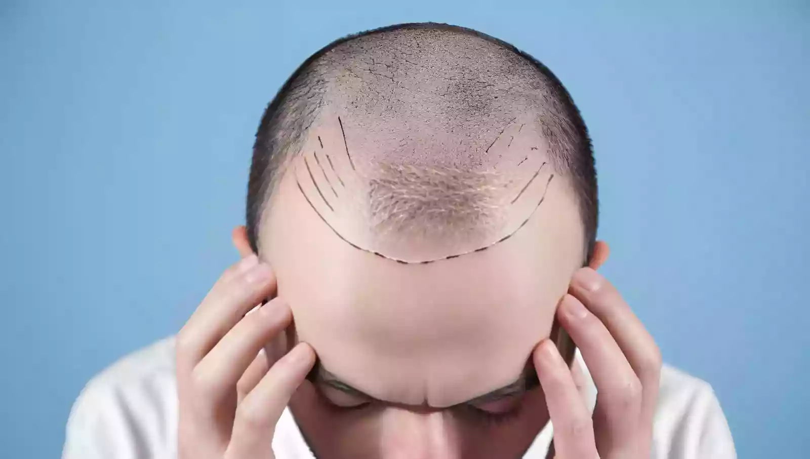 Hair transplant donor area planning