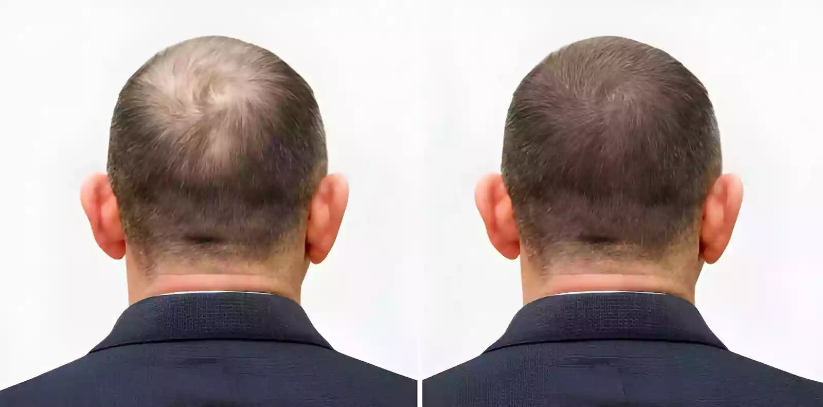 Hair Transplant in Beyoglu realistic results and planning