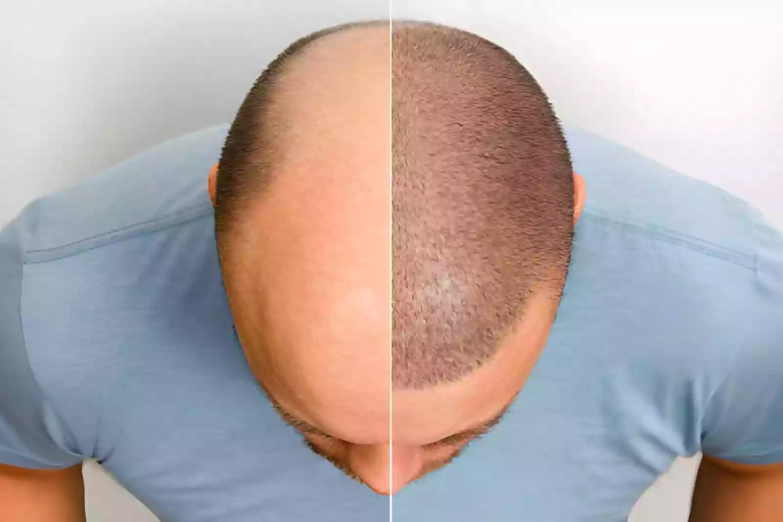 Hair Transplant in Istiklal